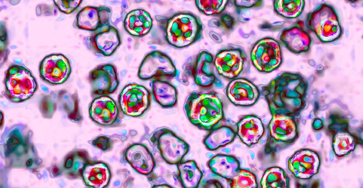 ¿Todavía puede obtener sarampión incluso si ha sido vacunado?