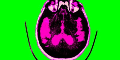 Buenas noticias sobre la investigación del Alzheimer, explicadas